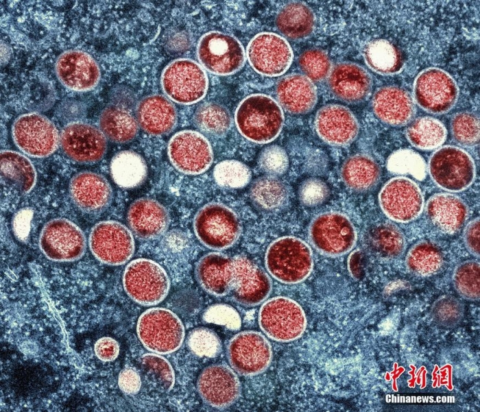 當地時間2022年7月26日，美國馬里蘭州，在實驗室培養的感染細胞(棕色)中發現的猴痘顆粒(橙色)的彩色透射電子顯微圖。世界衛生組織最近宣布，不斷擴大的猴痘疫情為全球緊急情況。這是世衛組織的最高警戒級別，但這一級別并不一定意味著疾病具有特別的傳染性或致命性。圖片來源：視覺中國